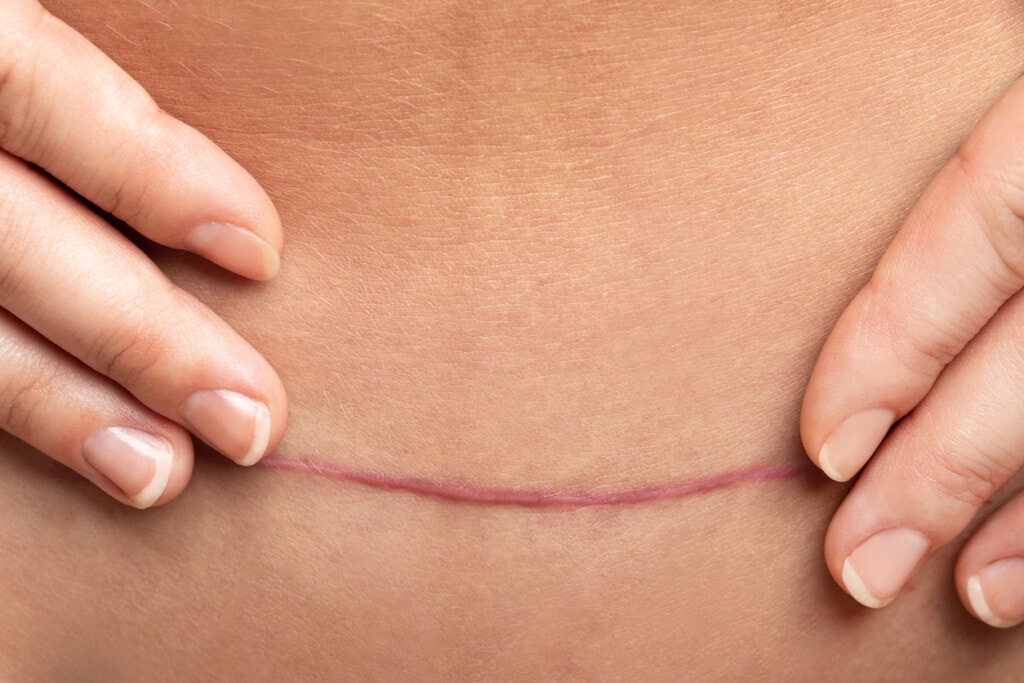 c-section Scar